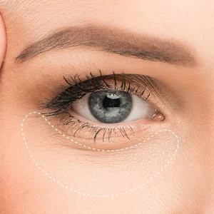 Redermalización de Ojeras Xela Rederm (3 sesiones)