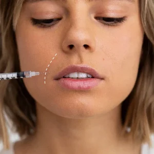 Relleno surco nasogeniano