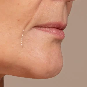 Relleno surco marioneta