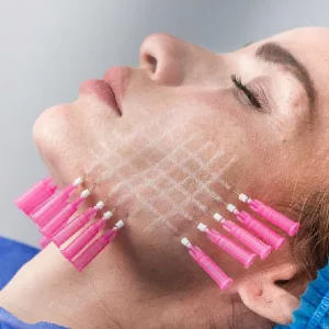 Hilos Revitalizantes (PDO)