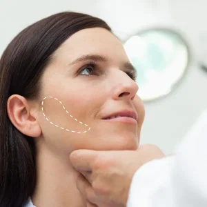 Bichectomía bilateral