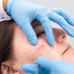 Hilos Tracción (PDO)