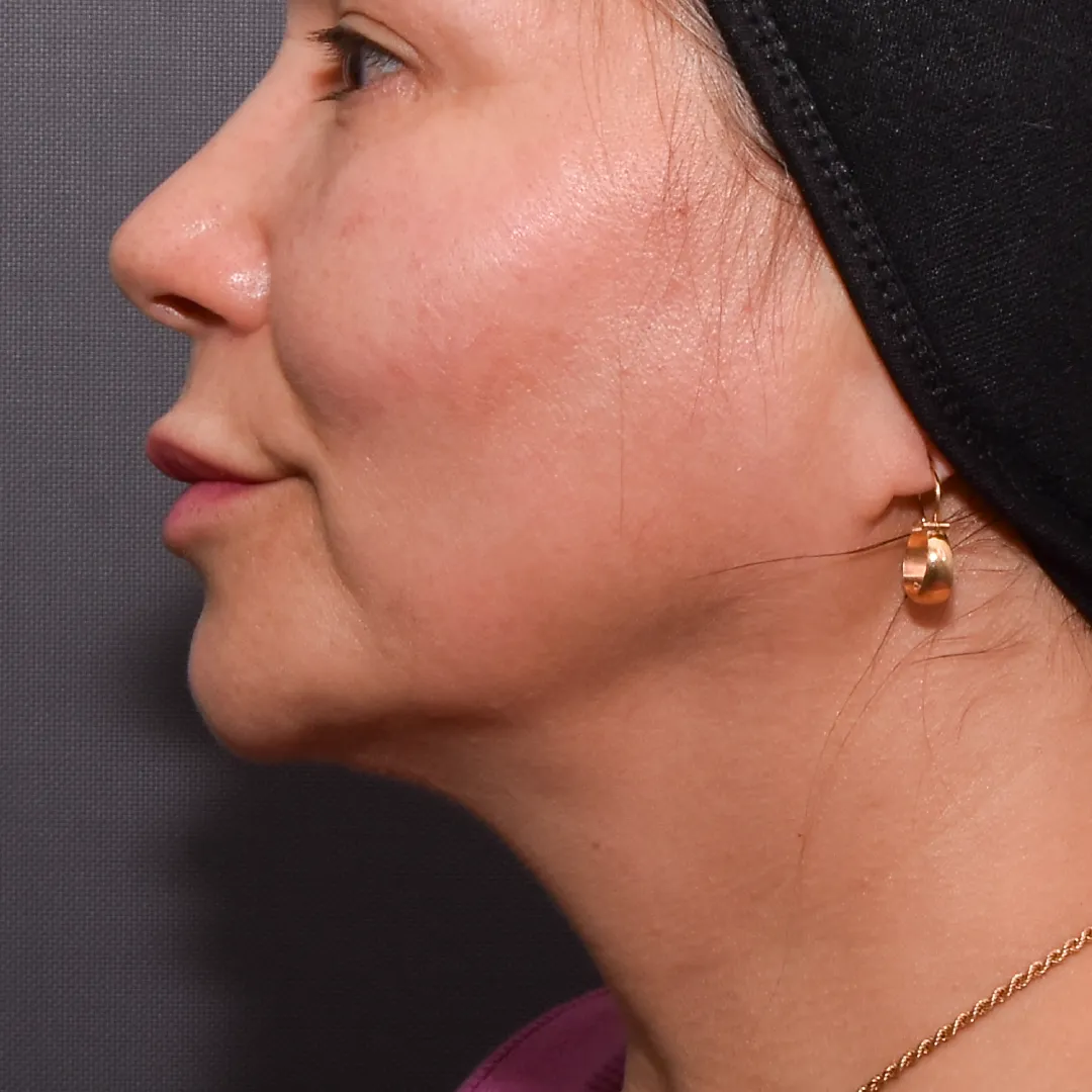 perfiladomandibular-19_11zon perfiladomandibular-19_11zon