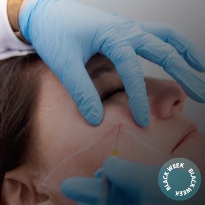 8 Hilos Tracción (PDO)